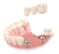 Zobni mostiček na implantatih